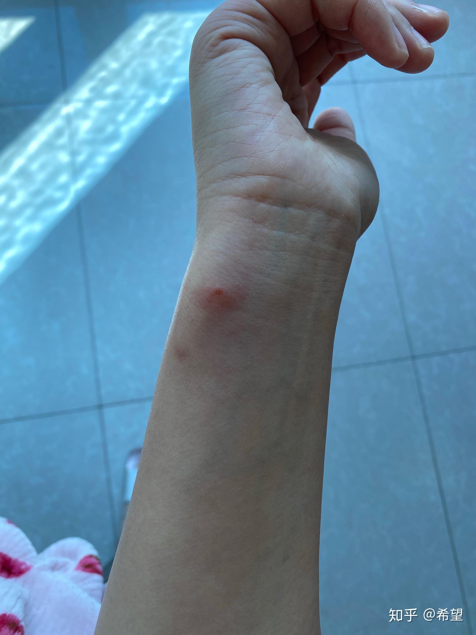 正在被丘疹性荨麻疹折麽的宝妈