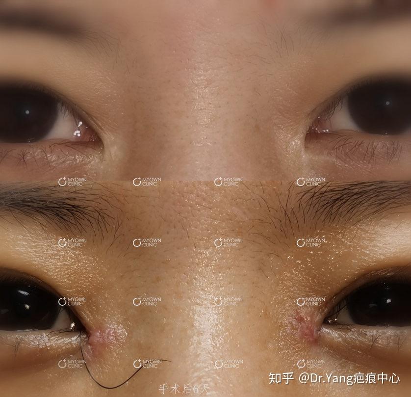 包眼角术后6天