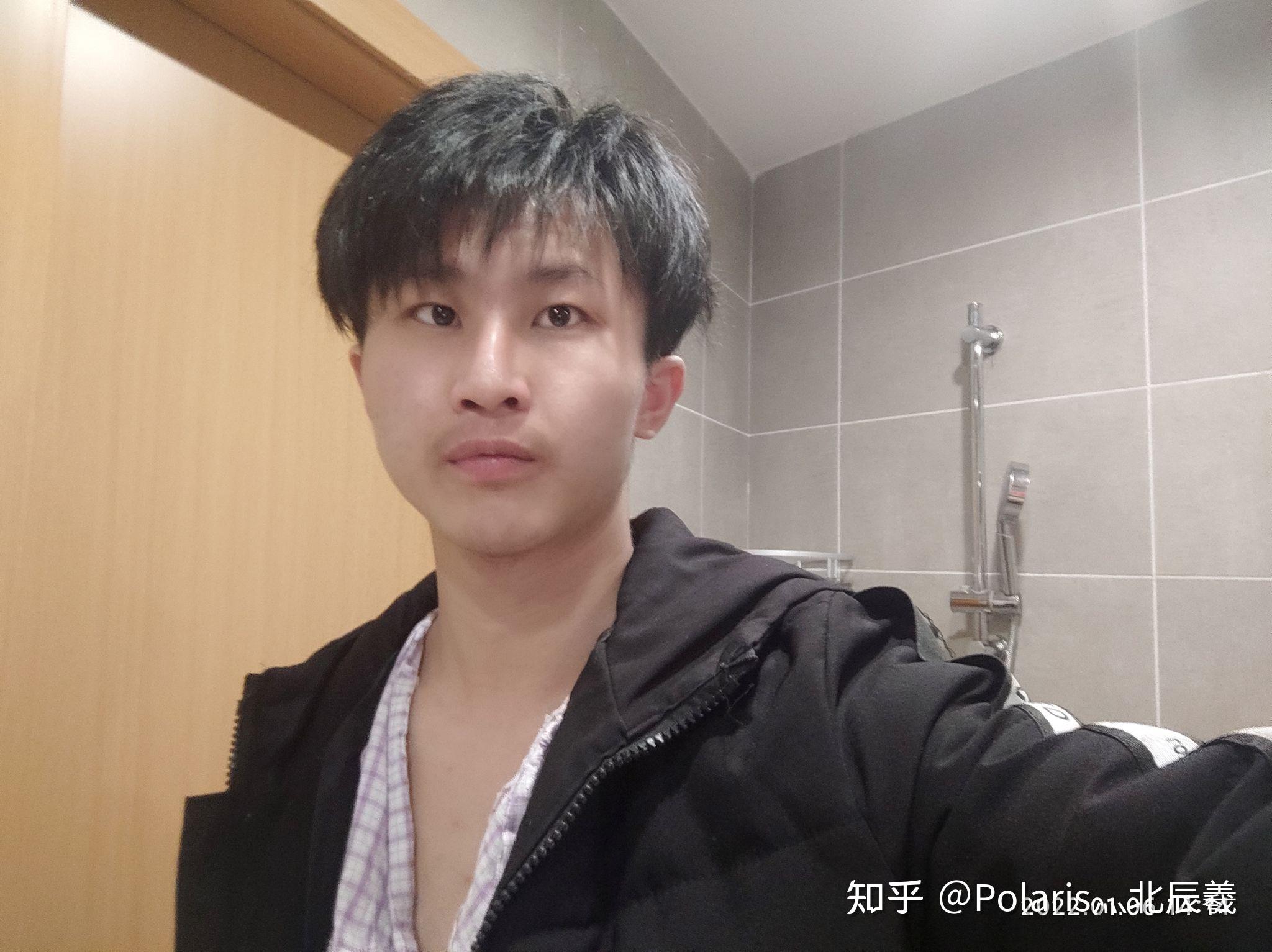 记藏毛窦手术 - 知乎