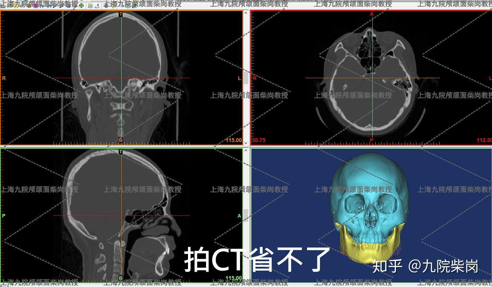 上海下颌角切的坑坑洼洼，只管营销不管技术，术后两侧下颌骨骨头缺失！ - 知乎