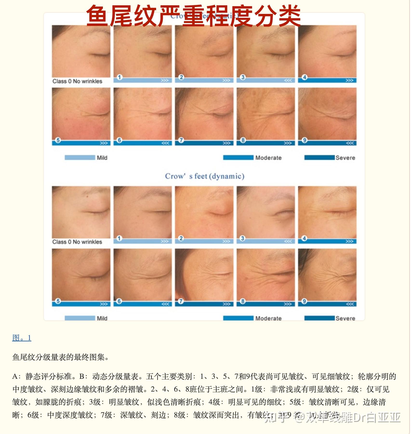 皱纹的分类以及严重程度等级划分 - 知乎