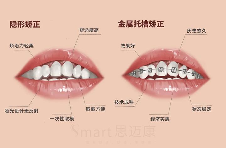 放弃传统钢丝矫正的我,选择了隐形矫正后怎么样了? - 知乎