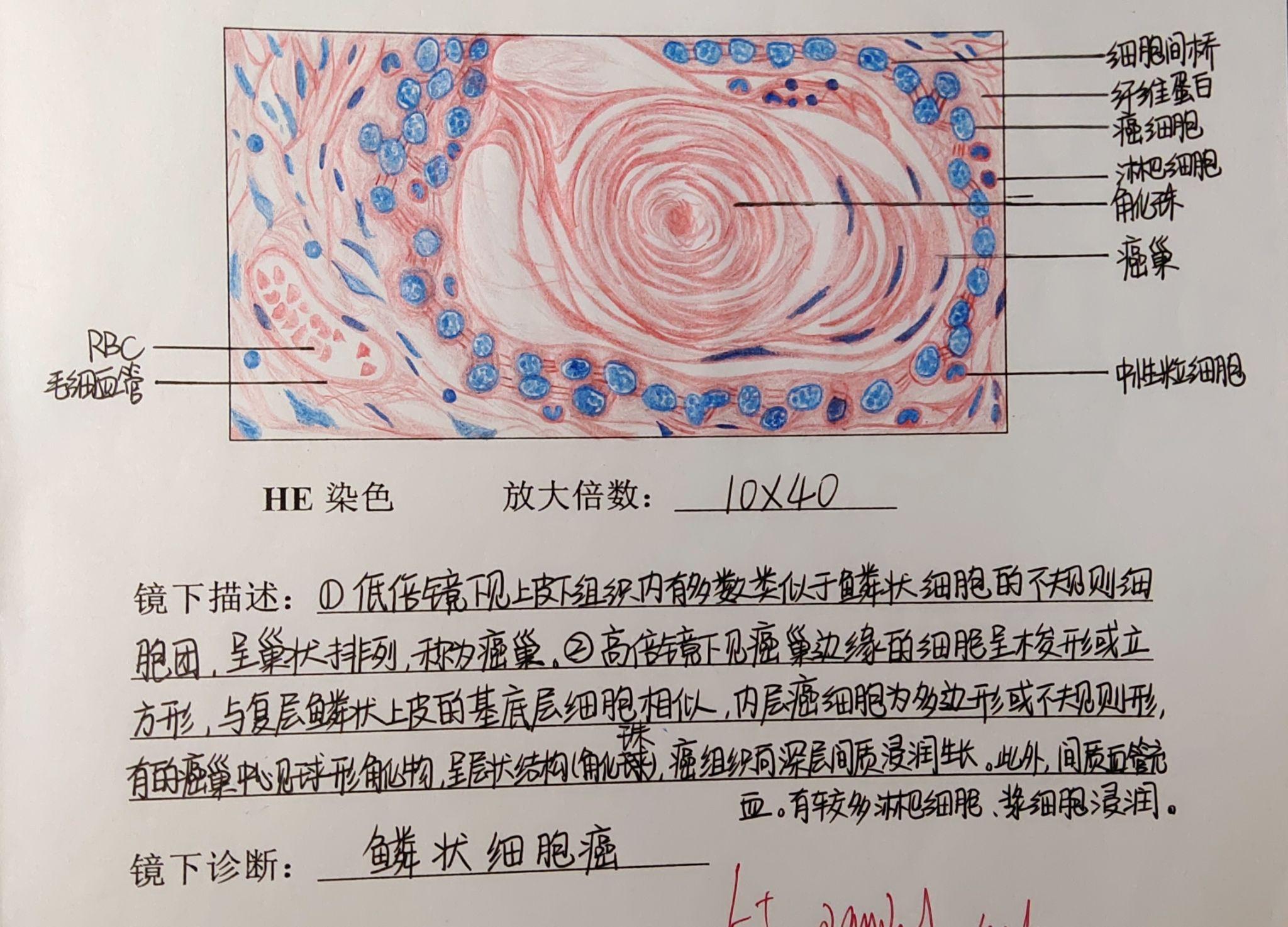 肾透明细胞癌红蓝铅笔图片