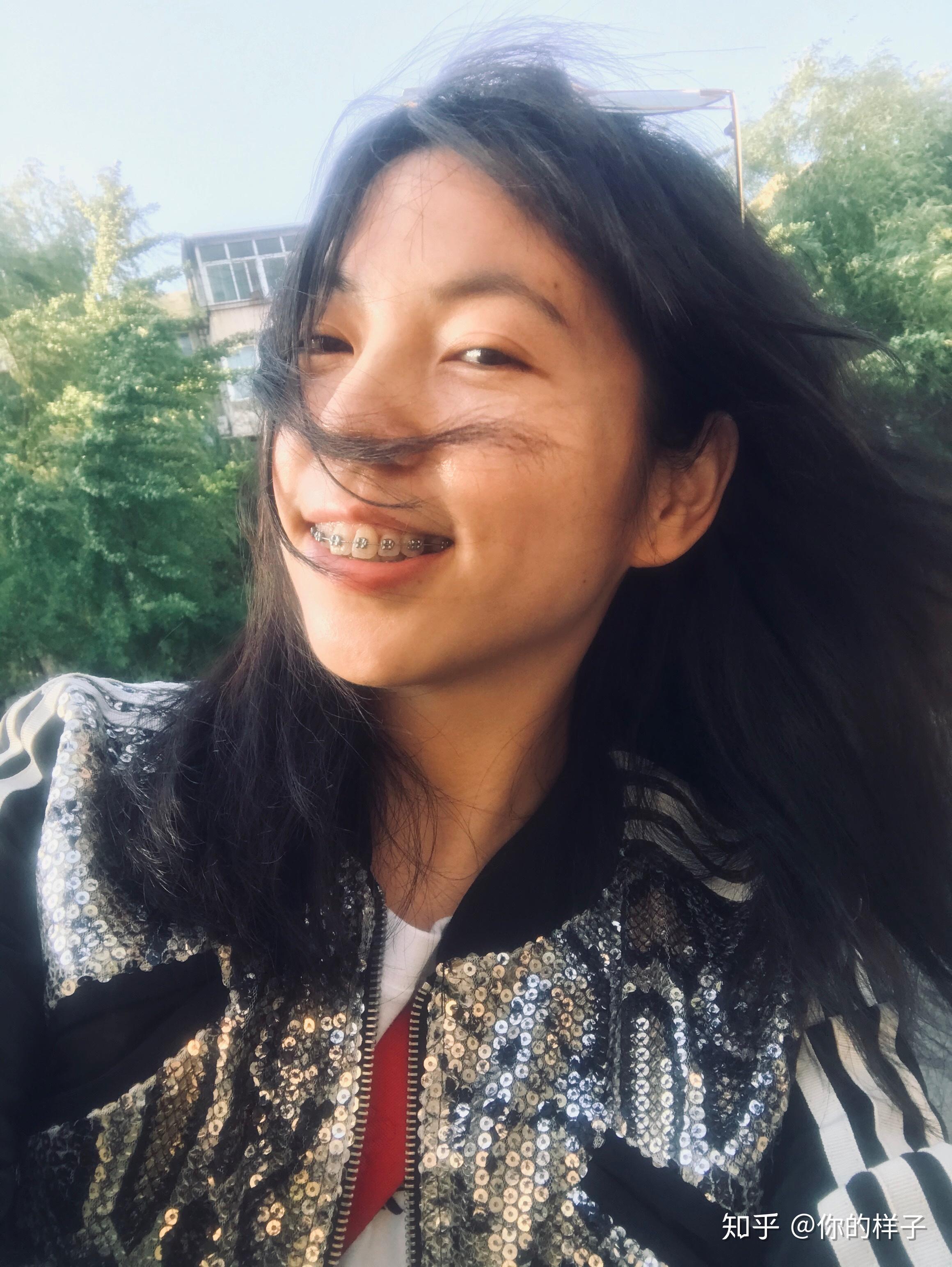 大龄女青年骨性嘴凸下巴后缩深覆合