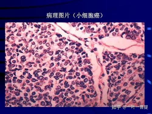 肺癌四种类型 肺腺癌 肺鳞癌 小细胞肺癌 有什么特点 怎么治疗 知乎