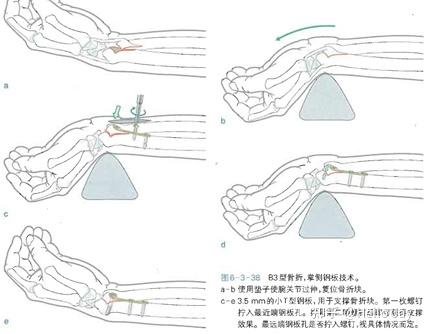 组织情况和骨折本身tfcc和腕部韧带损伤(尤其是舟月韧带和月三角韧带)