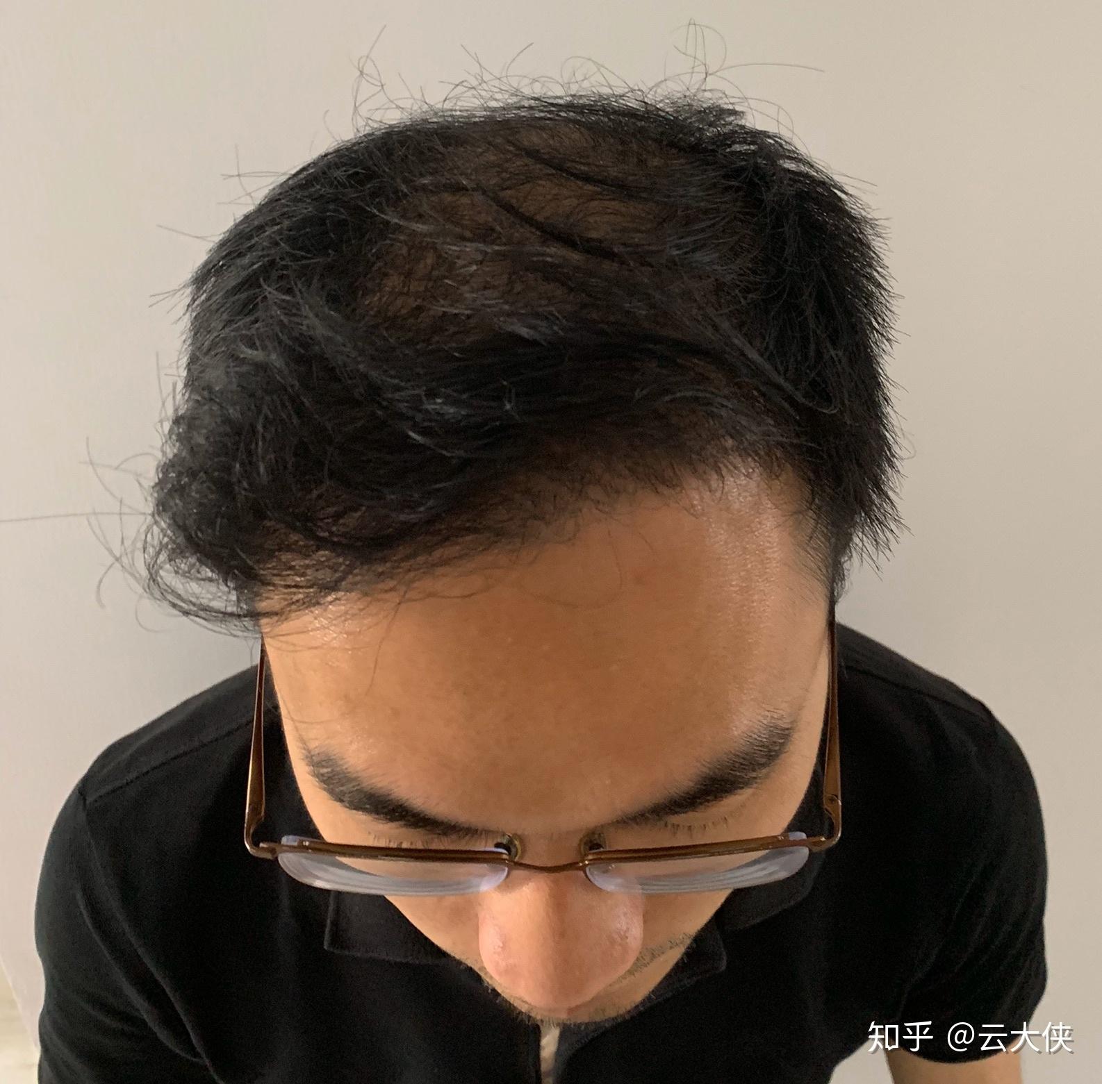 雄性激素源脱发，确实是不可逆的吗？?