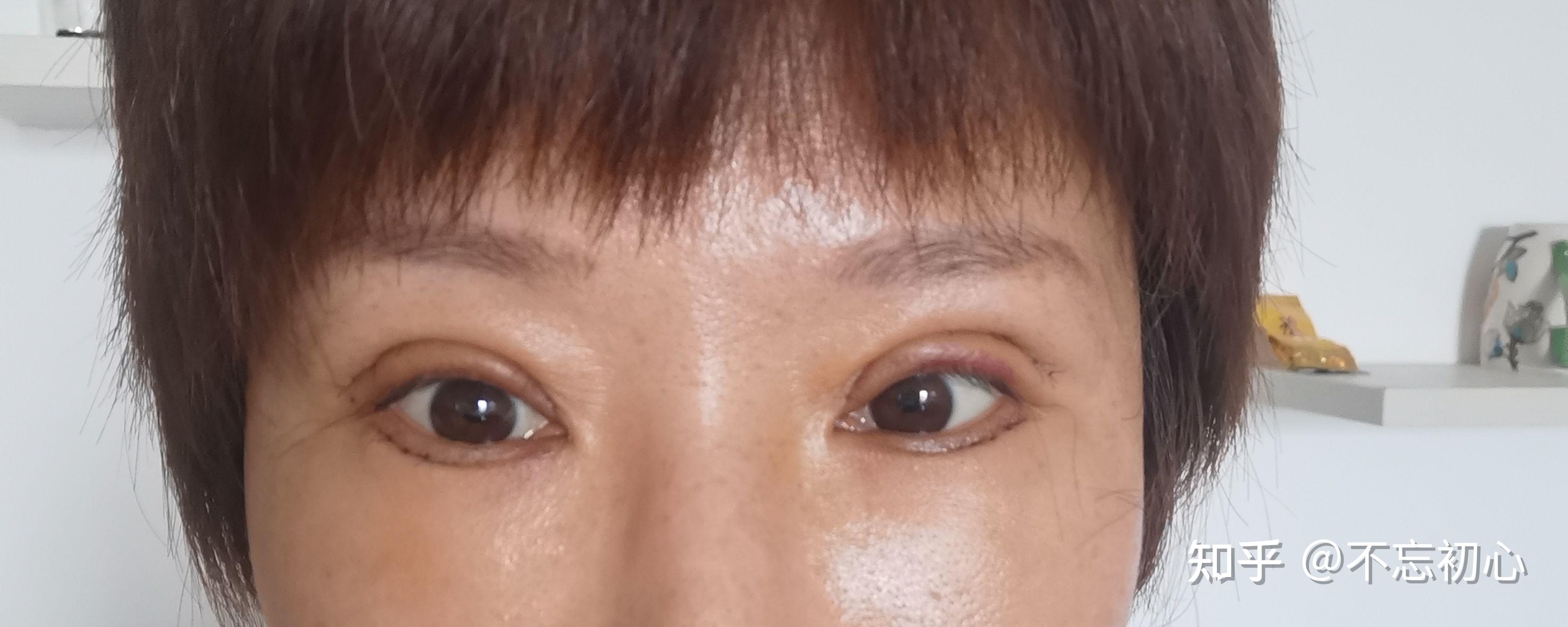 张冰洁双眼皮修复案例丨双眼皮窄变宽修复+内眼角疤痕修复+开外眼角综述 - 哔哩哔哩