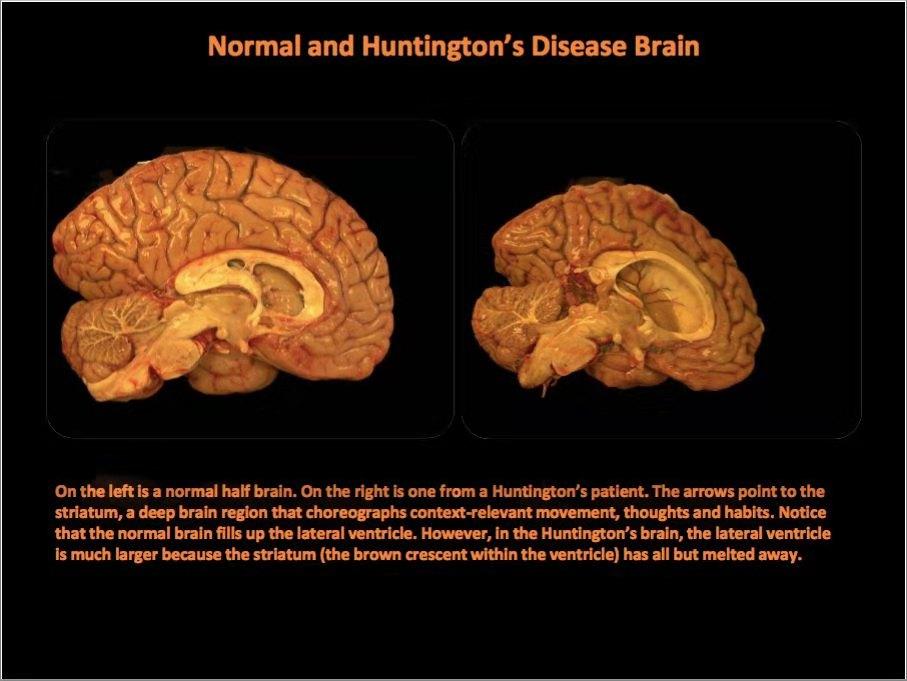 致命之舞亨廷顿舞蹈病