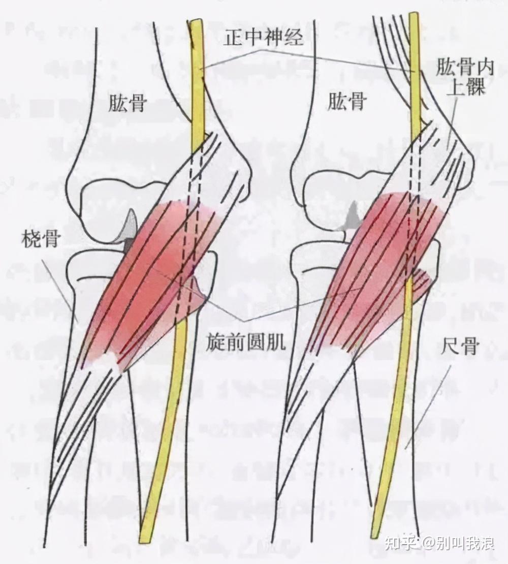 當我們將旋前圓肌處於一個肌肉放鬆的位置,患者症狀當場緩解,那麼基本