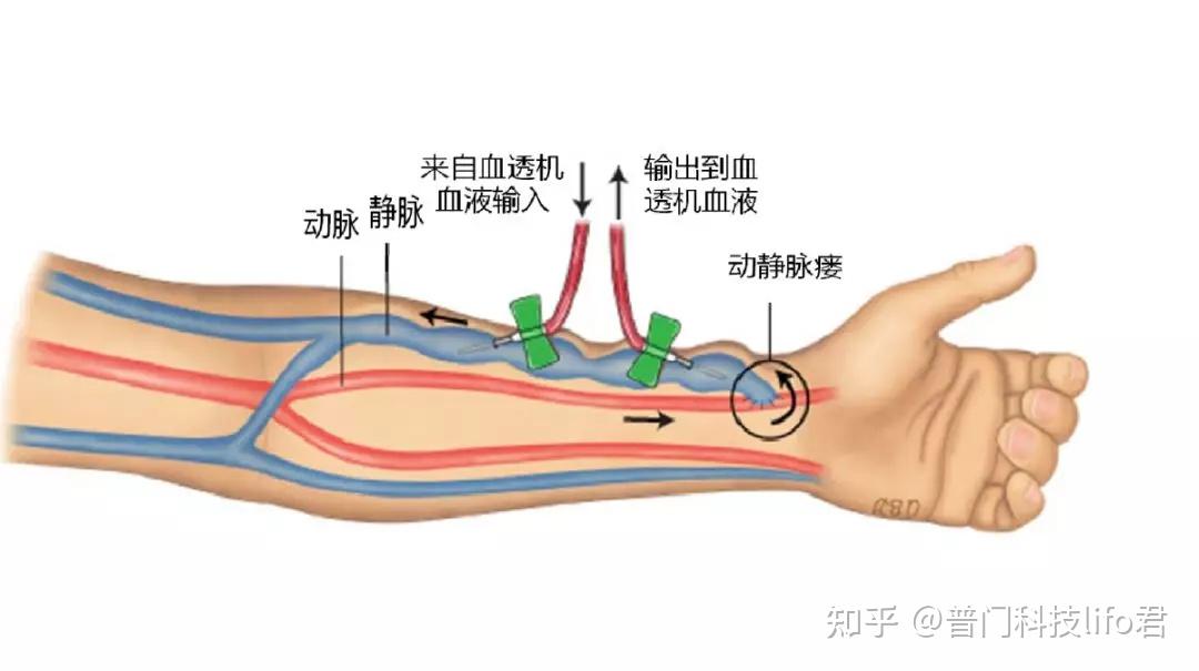 血透患者的生命線動靜脈內瘻護理