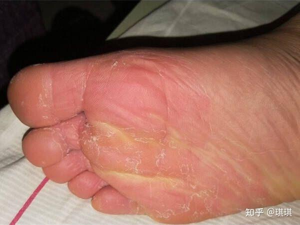 马上又到夏天了,看到不少小姐妹又开始满世界打听去脚气的办法,今天我