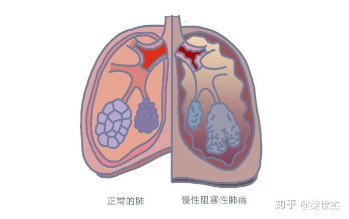 肺胀,慢性阻塞性肺气肿的深度解析 - 知乎