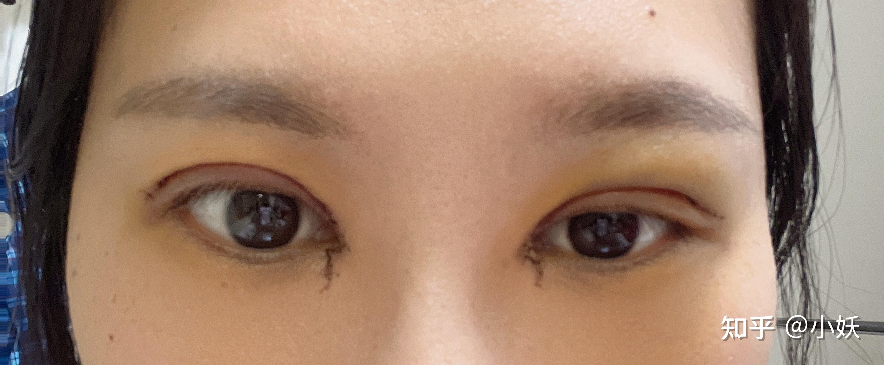 在韩国做双眼皮术后一个月恢复图来袭～ - 知乎