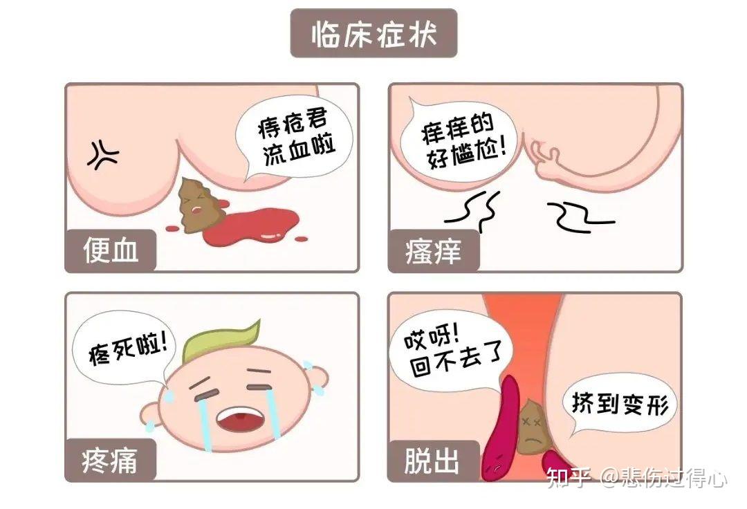 痔疮手术后要多久才能上班