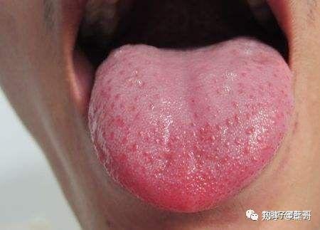 第一类:心火旺:能量和物质在心经区出现瘀滞了,类似河流上游堵塞.