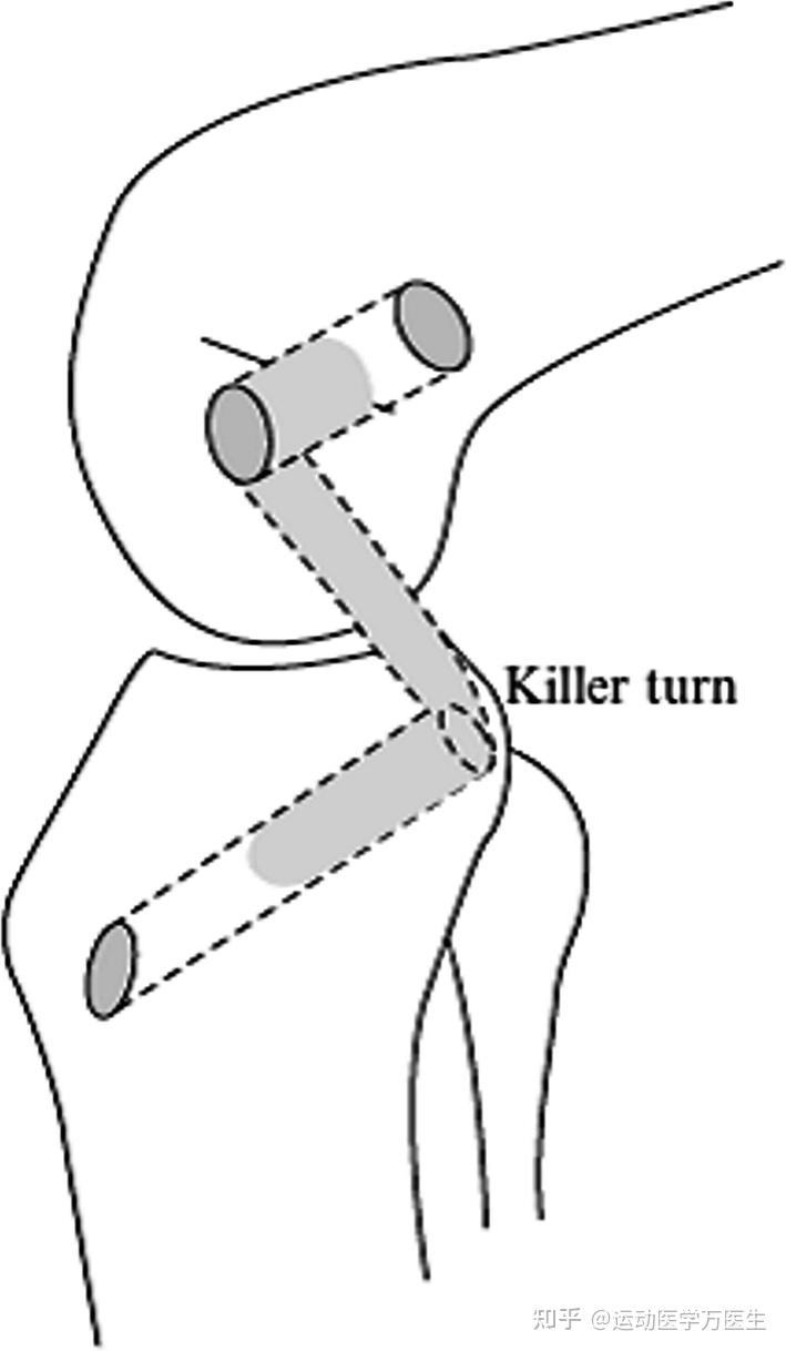 后交叉韧带撕裂了该怎么办