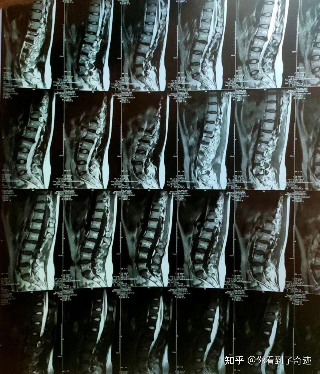 正常的腰椎骨真人图片图片