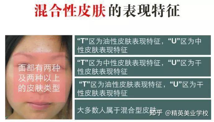 混合性皮肤