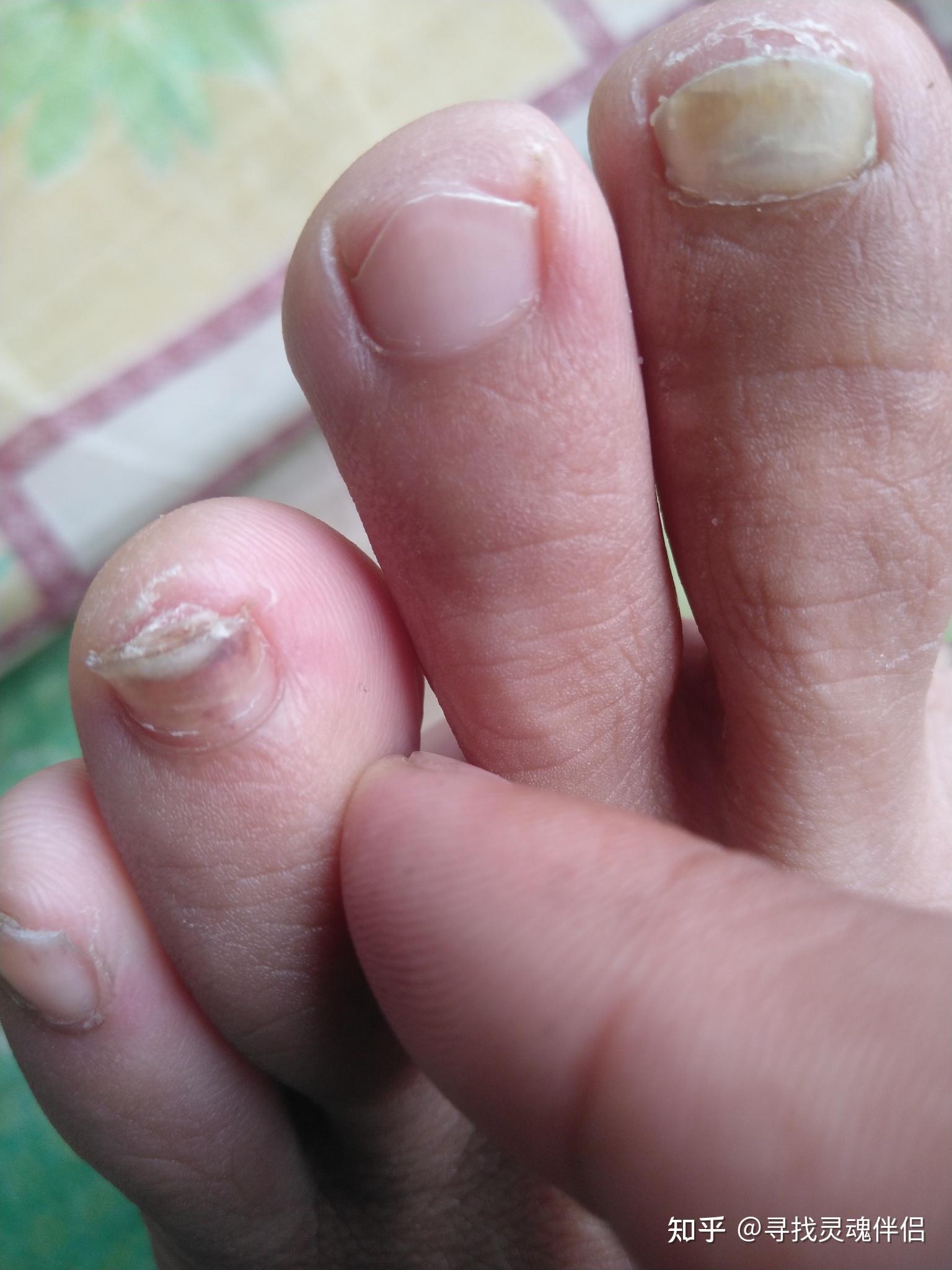 打球弄伤脚趾甲