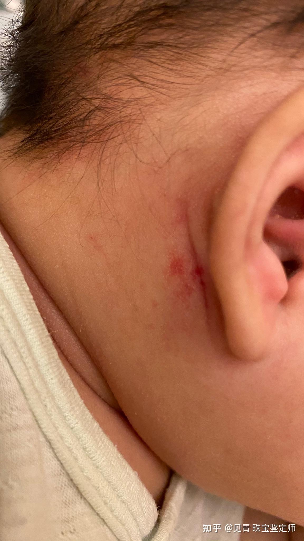 新生儿腮腺区血管瘤治疗进展