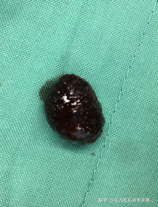 胆囊内单枚结石保胆取石是很好的选择