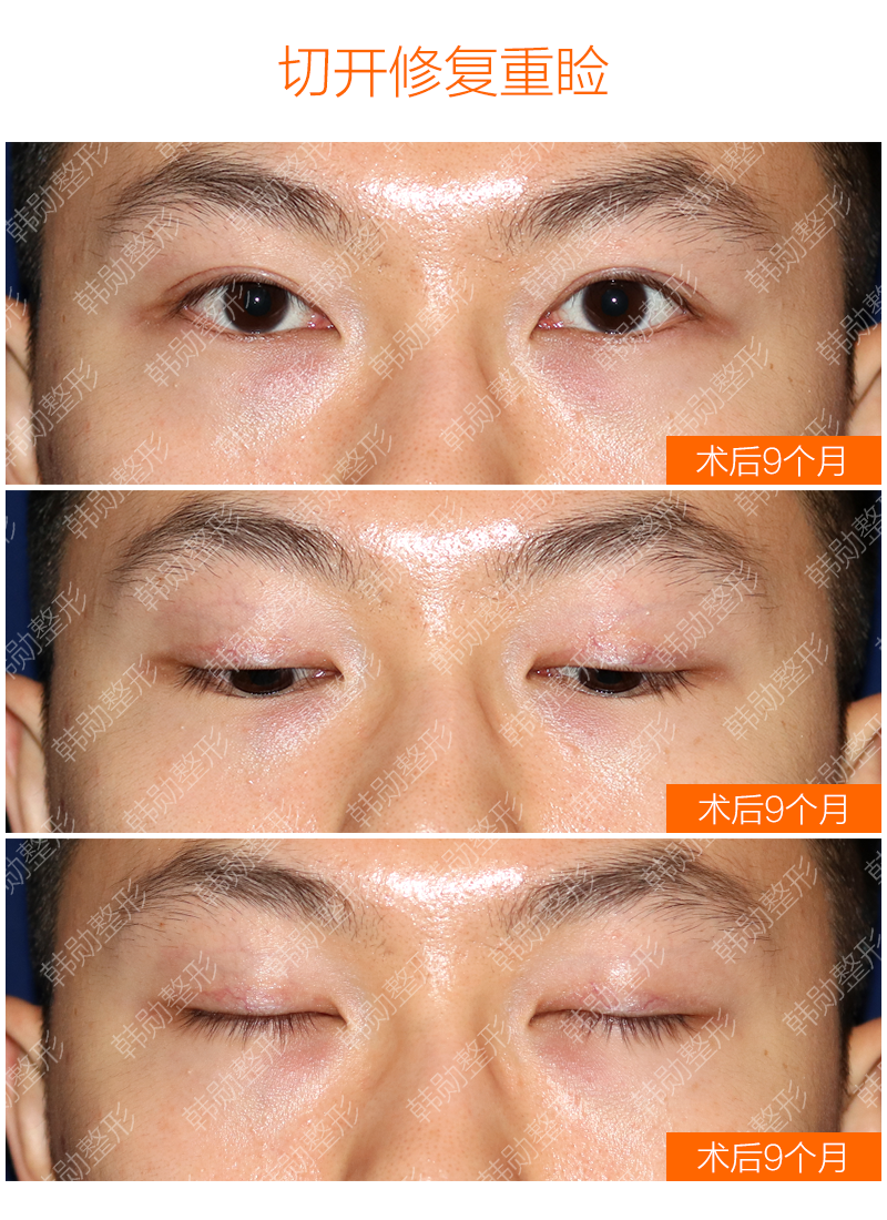 韩勋双眼皮修复无力大小眼的改变