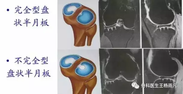 盘状半月板发病率图片