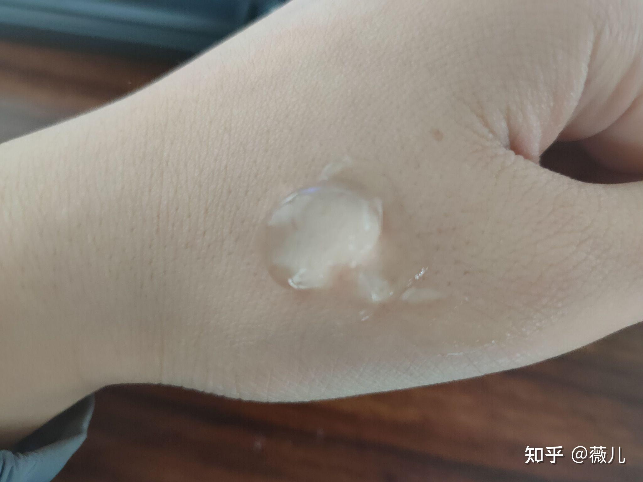 痘痘变成硬的,变成一个大包还能好吗?