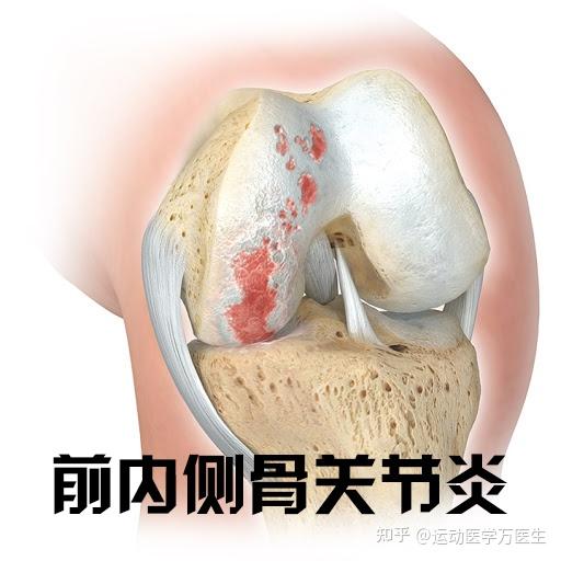 有些o形腿的膝关节骨关节炎,只用换一半关节就够了 