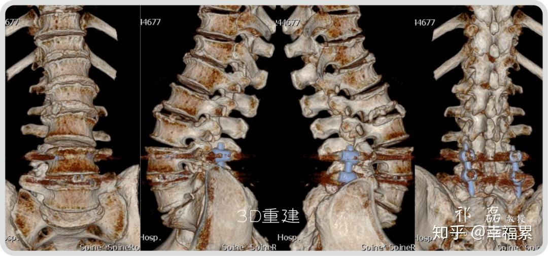 圖5:術後即刻腰椎正側位x線圖4:術後即刻腰椎正側位x線術後影像資料圖