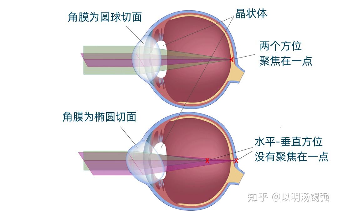 这个孩子散光轴位为何如此波动？ - 知乎