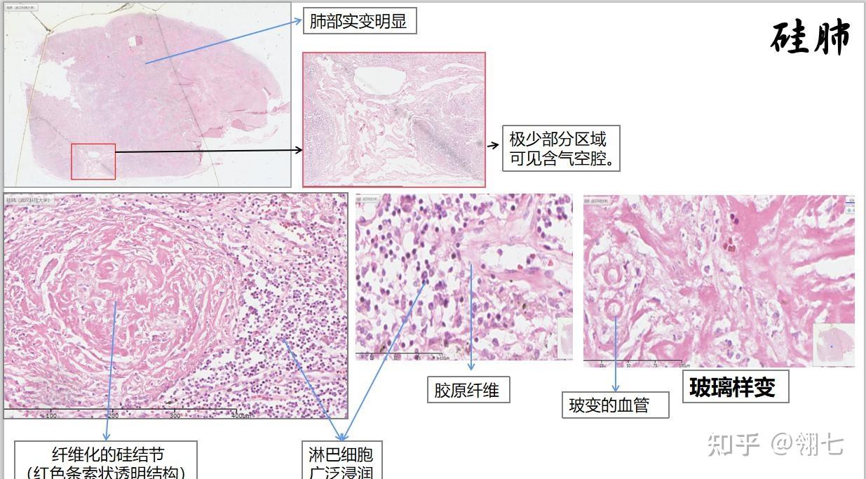 角化珠癌巢图片