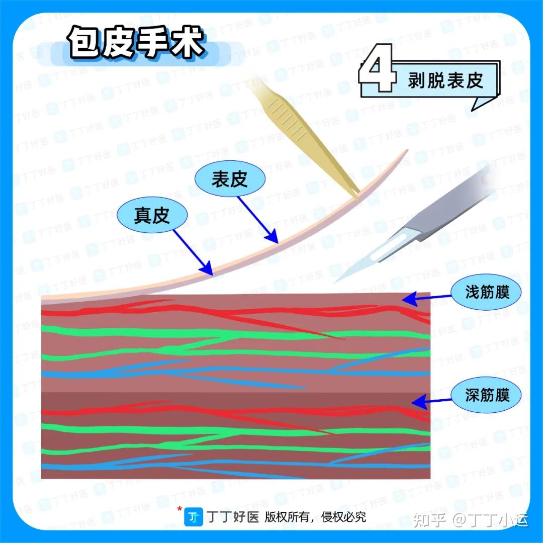 割包皮,对性功能的10个影响(下) - 知乎