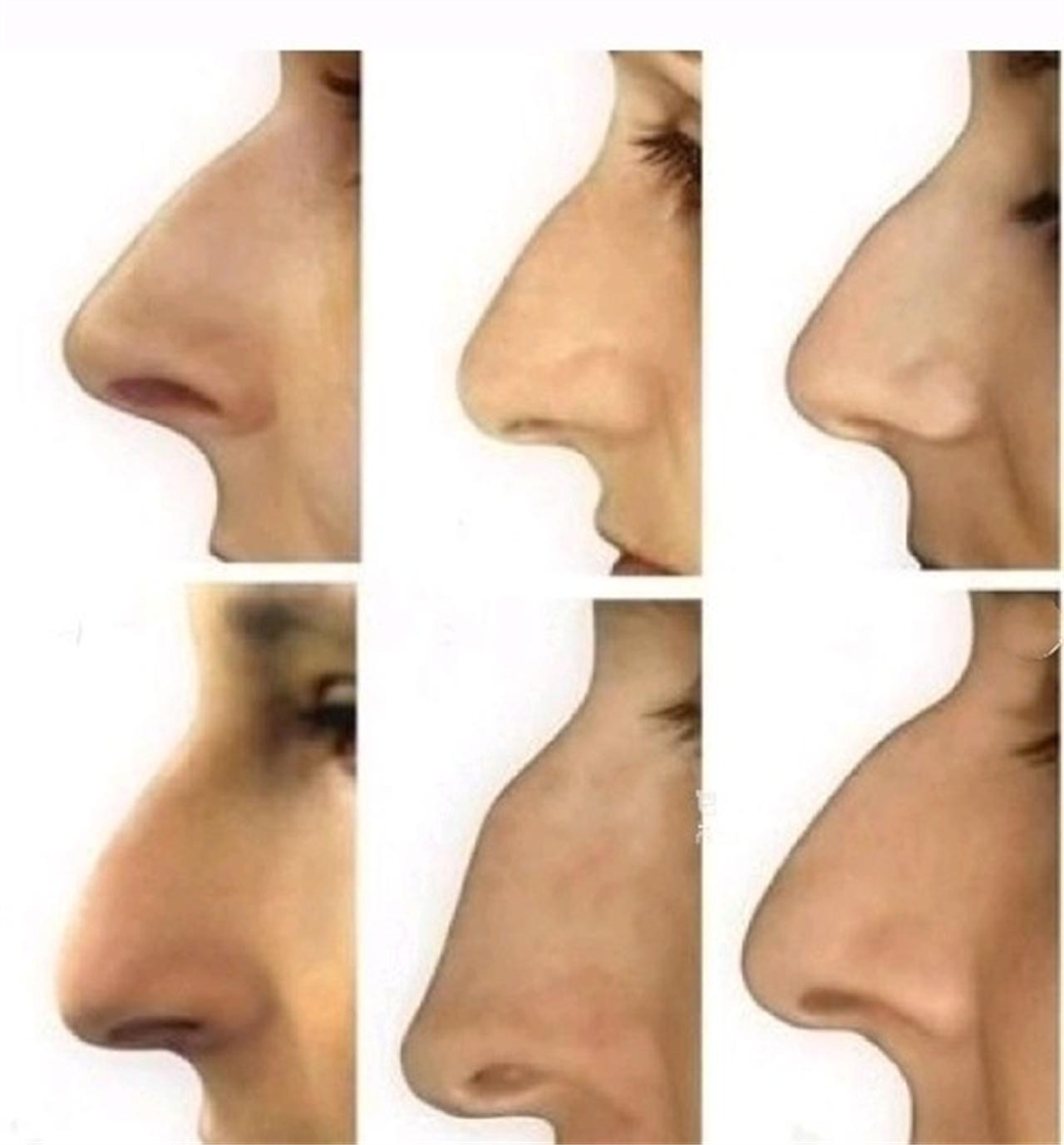 三,鹰钩鼻:又叫结节鼻,是指在鼻梁的上端有凸起,形似驼峰或结节状