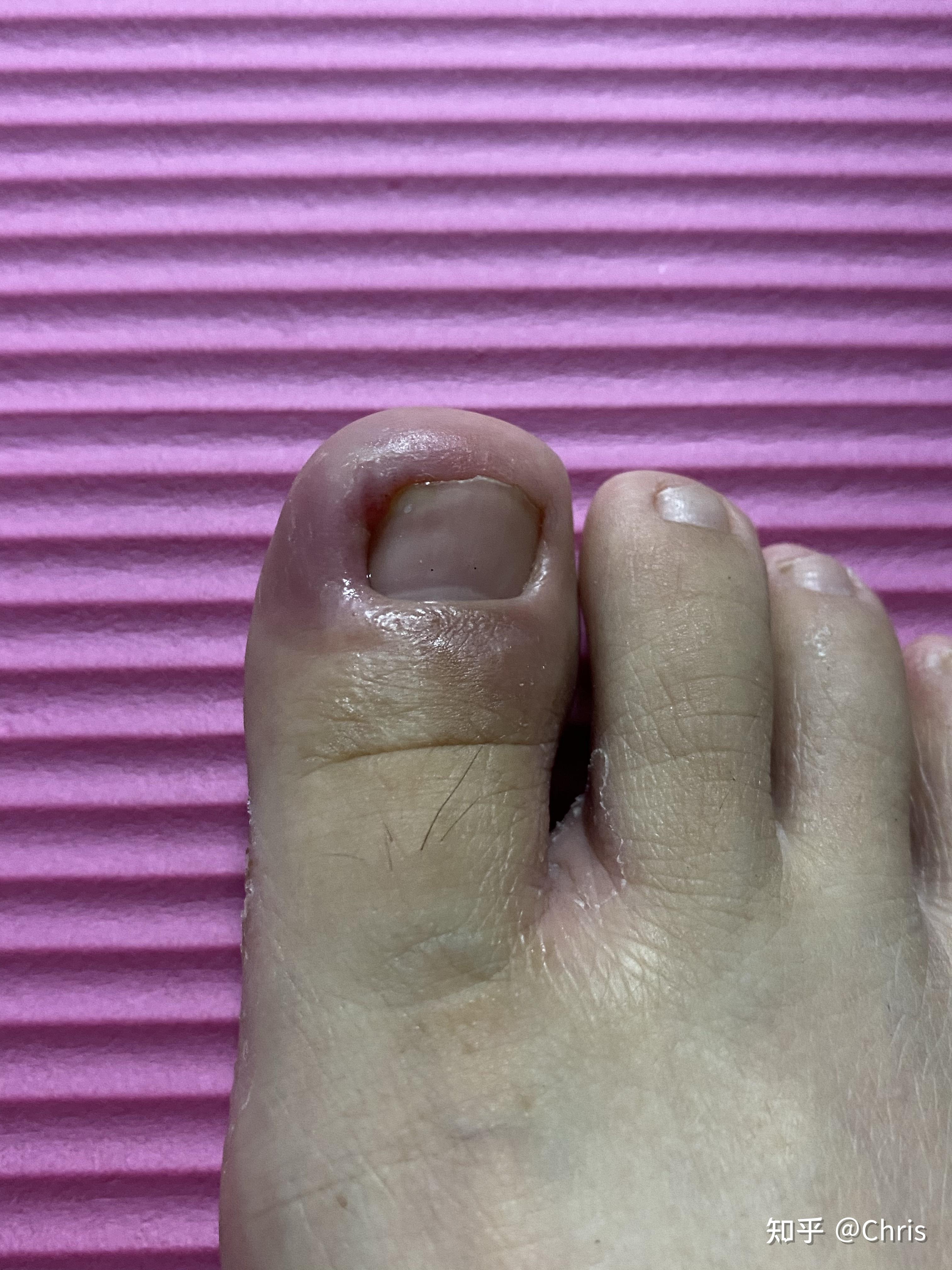 甲沟炎患者 - 知乎