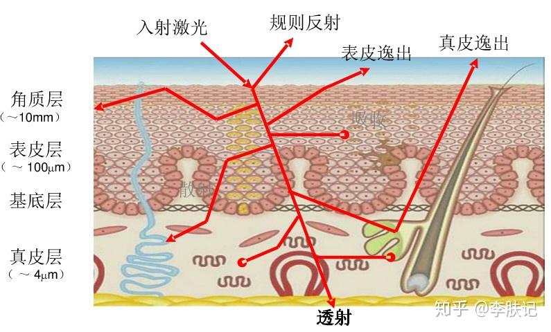 激光照射皮肤的过程