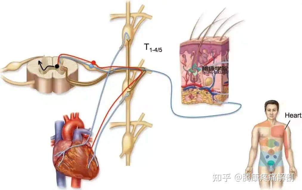 牵涉痛