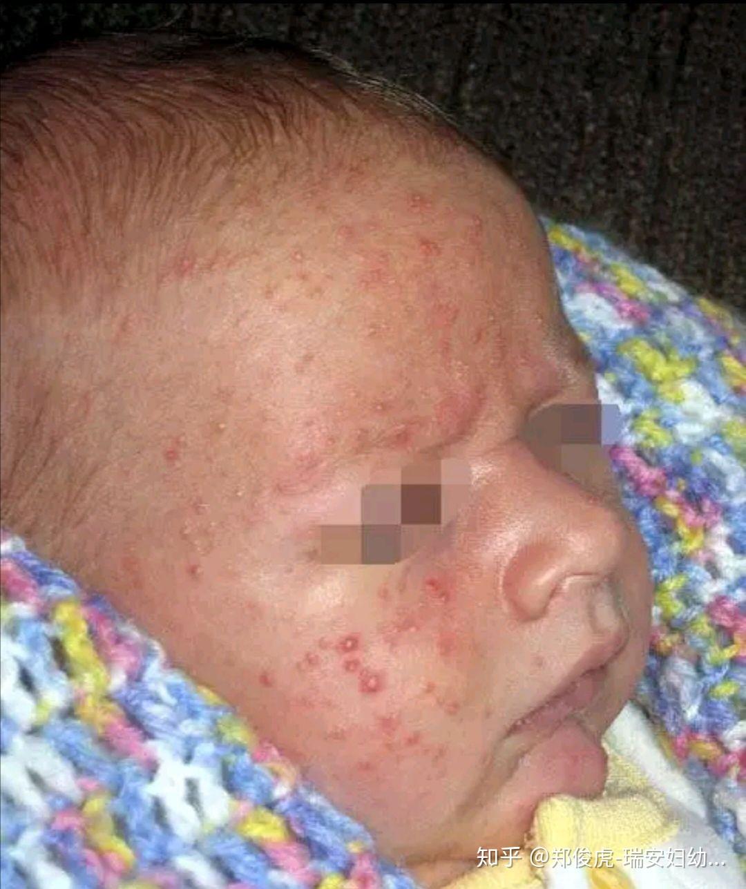 婴儿痤疮严重疤痕图片图片