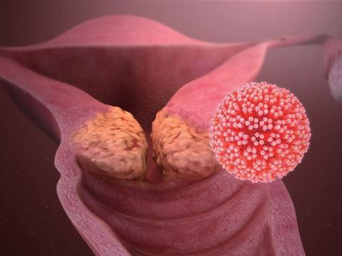 hpv 即人乳頭瘤病毒,可導致良性腫瘤(生… 閱讀全文 贊同