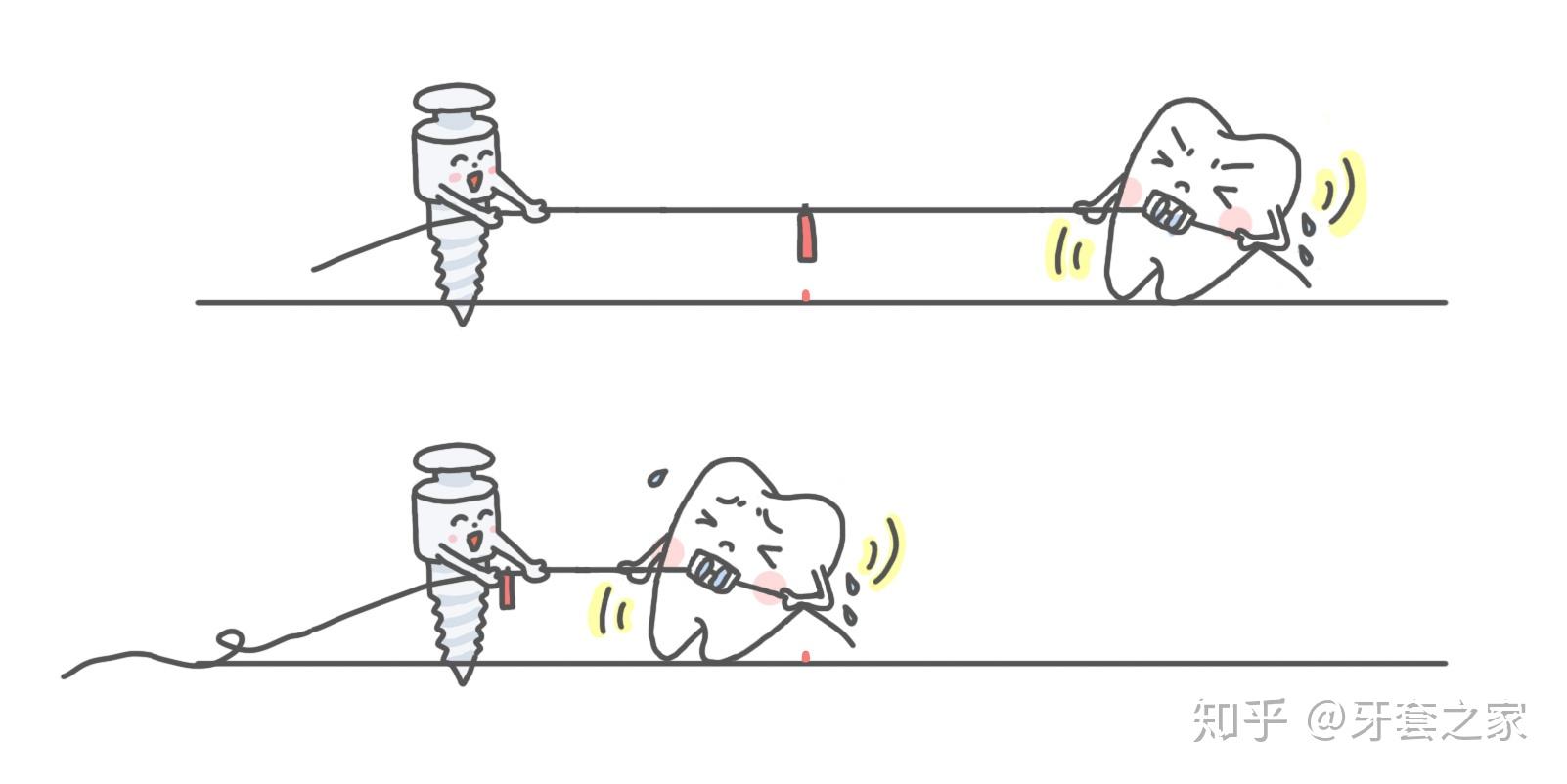 科普 | 牙齿矫正的"利器"——支抗钉(骨钉)