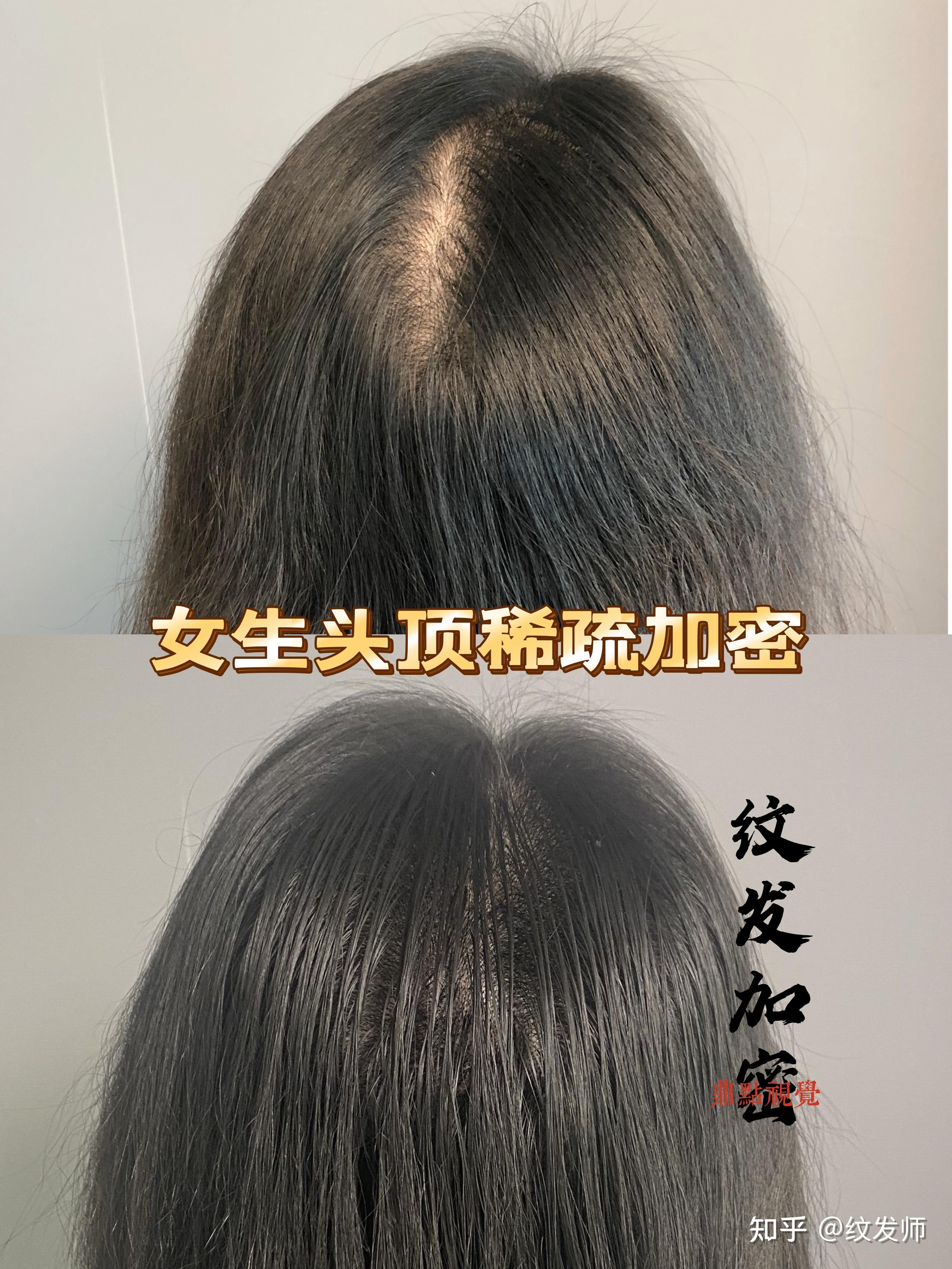 纹发对于女生头发稀疏,露头皮明显的改善效果如何?