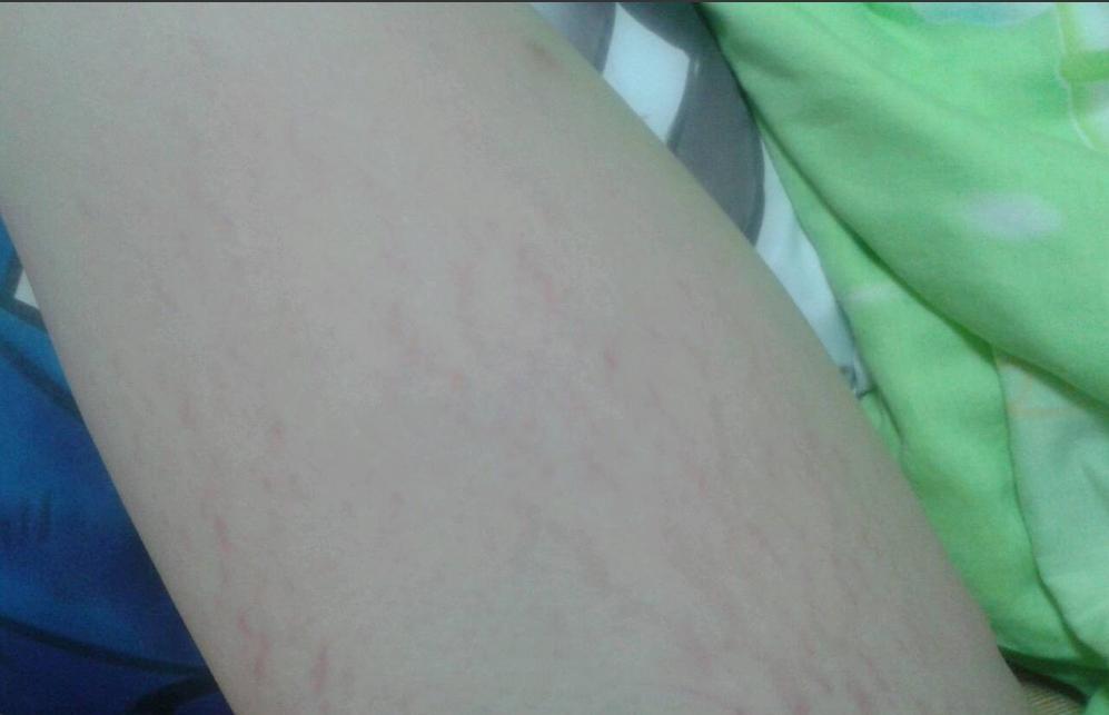 生长纹肥胖纹可以消除吗这些纹路是怎么形成的