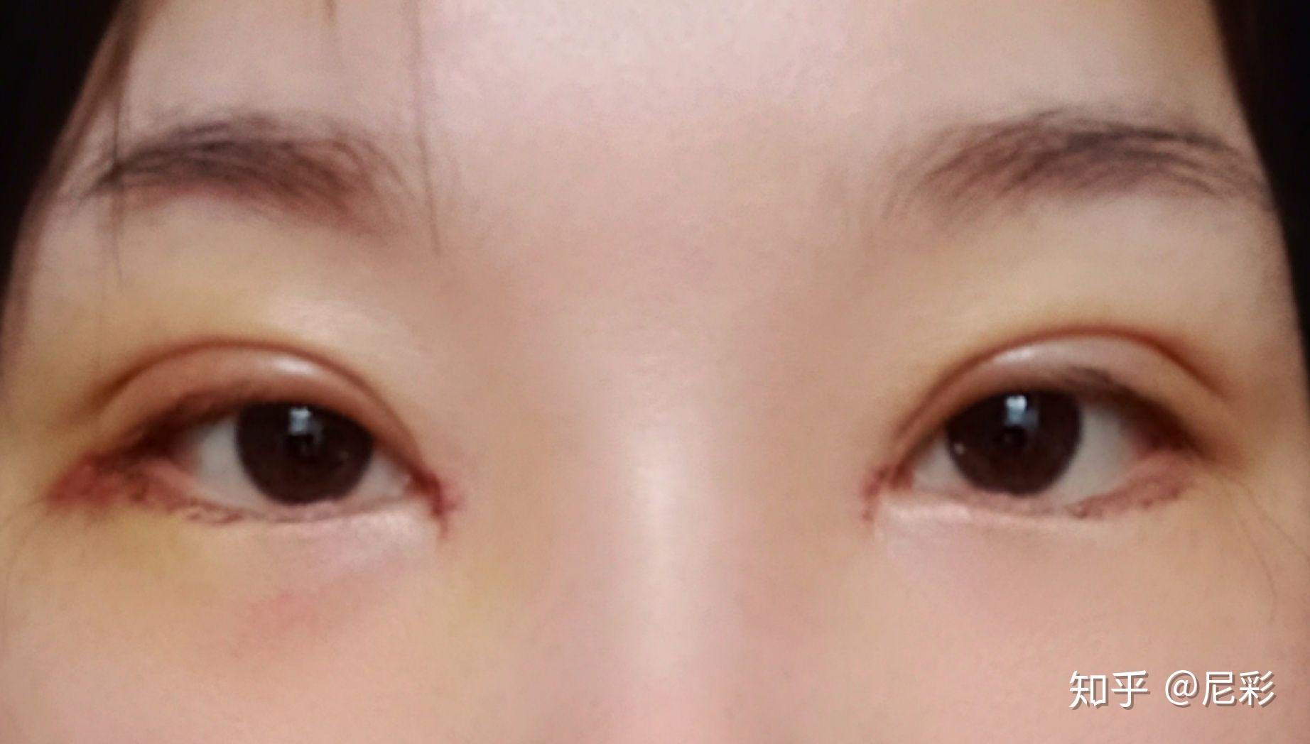 双眼皮的种类如何区分和选择呢？ - 知乎