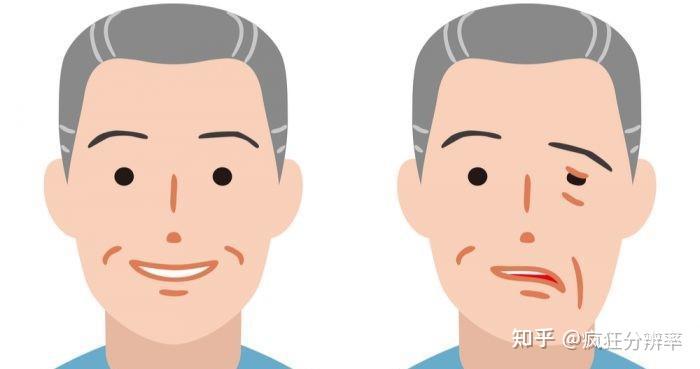 中风的前兆有什么症状? - 知乎