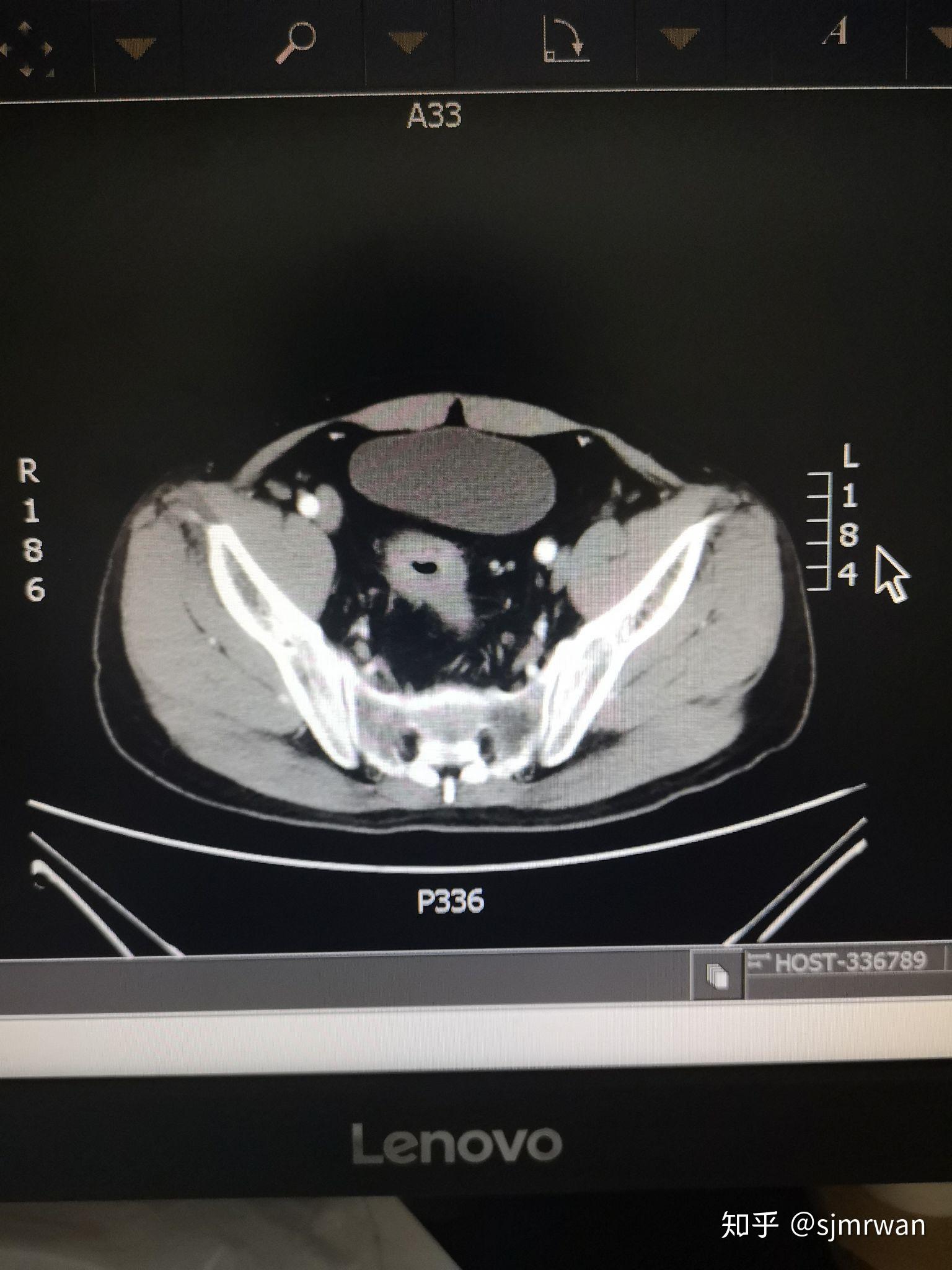 直肠癌一例 - 知乎