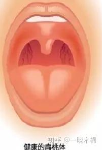 腭舌弓滤泡增生图片