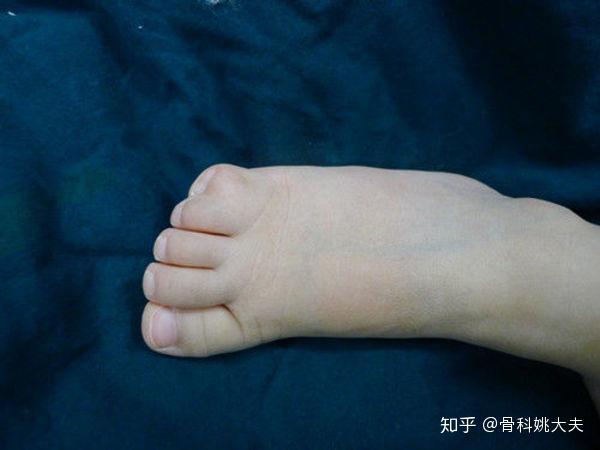 脚趾并指有没有做手术的必要,这篇文章告诉你 - 知乎