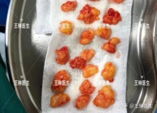 哪些情况下脂肪瘤需要考虑手术切除