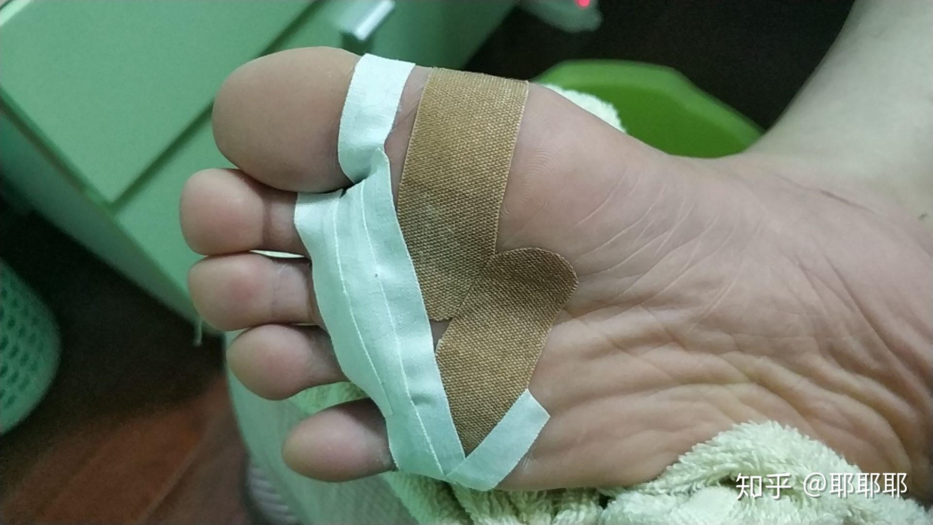 更新530治愈我用阿司匹林和阿昔洛韦药片粉末治疗跖疣的经验分享